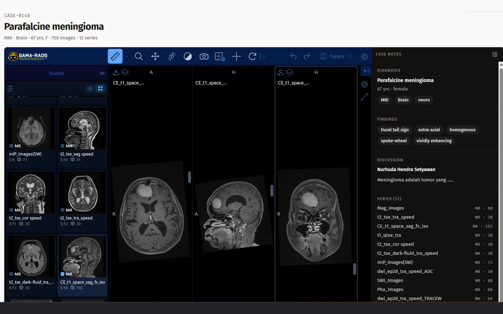 A brain MRI case open in the viewer: axial, coronal and sagittal series side by side, with diagnosis, findings and the consultant’s discussion in a panel beside them.